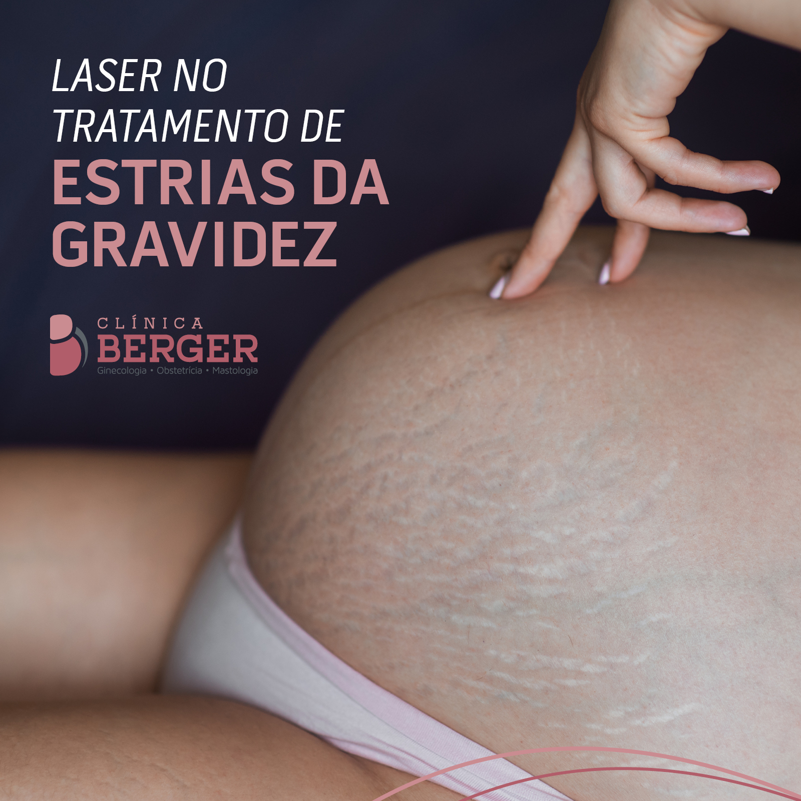 Laser no tratamento de estrias da gravidez